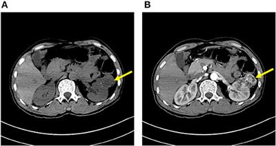 Anti-N-Methyl-D-Aspartate Receptor Encephalitis Associated With Clear Cell Renal Carcinoma: A Case Report